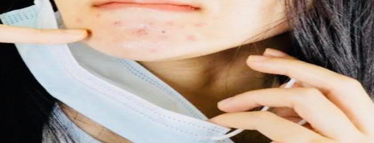 ACNE