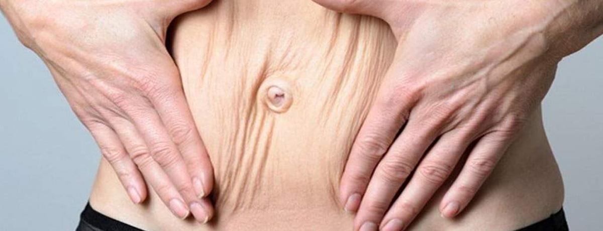 Flacidez tissular e muscular podem ser combatidas com equipamentos de estética.